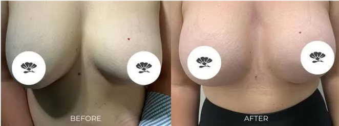 Hasil alami atau lebih bervolume di atas? Ini rahasia beda implan bulat vs tetesan air mata!