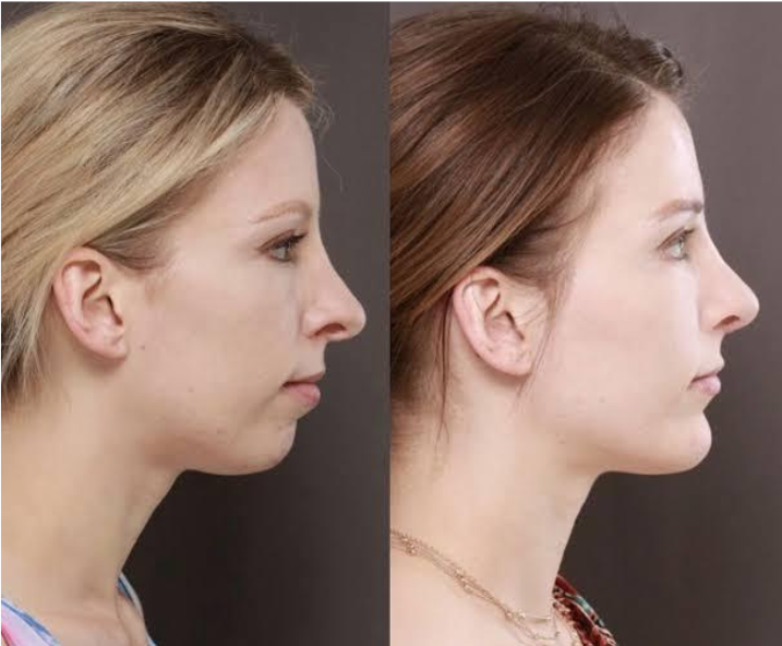 Jangan biarkan dagu pendek merusak estetika profil wajahmu! Cek fakta chin augmentation di sini.