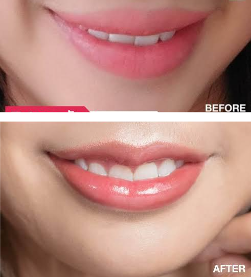 Mau bibir tampak lebih plump, kenyal, dan proporsional? Cek fakta medis prosedur bibir kastanye!