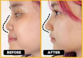 Mau hasil pembentukan hidung yang presisi dan tahan seumur hidup? Intip faktanya di artikel ini!