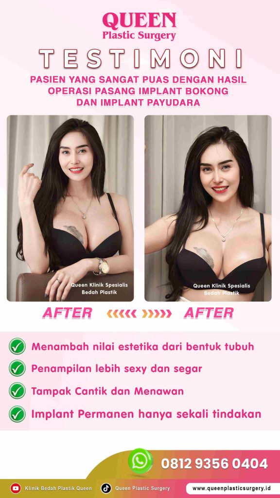 Stop bingung menentukan profil implan! Pelajari kecocokan jenis dan bentuk implan payudara dengan postur tubuhmu.