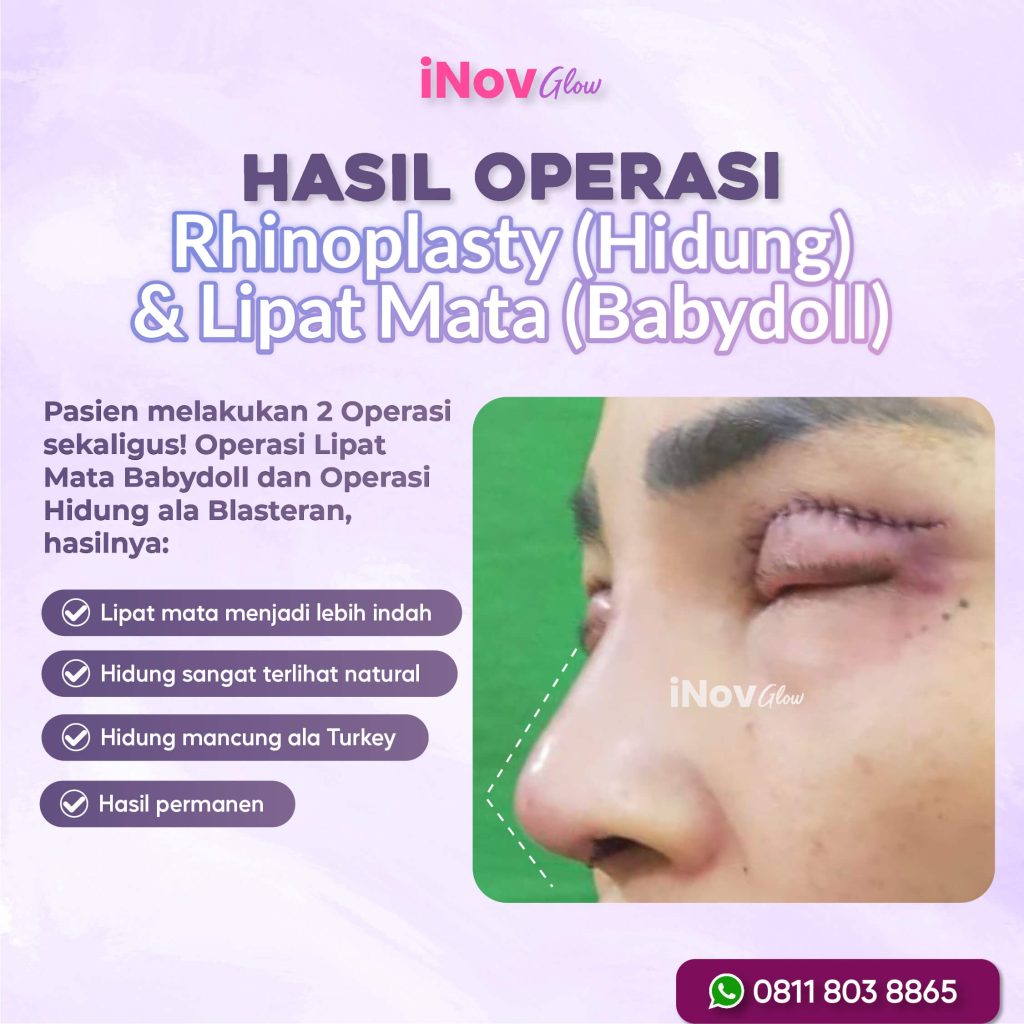 Rahasia Mata Fresh Artis Tanpa Kerutan Terbongkar! Yakin Cukup Satu Prosedur Saja? Klik link untuk jadwal konsultasi Dr. Heri Noviana!