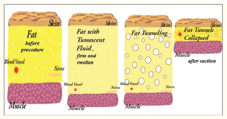 Infografis dampak liposuction terhadap metabolisme lemak tubuh secara medis.