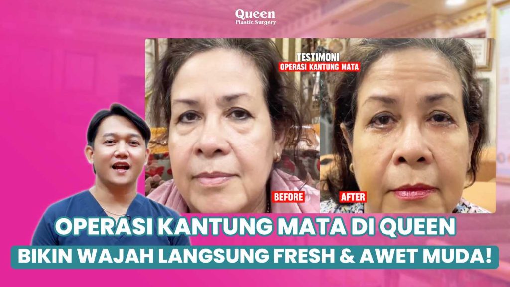 Solusi kantung mata kendur dengan prosedur blefaroplasti bawah oleh spesialis bedah plastik.