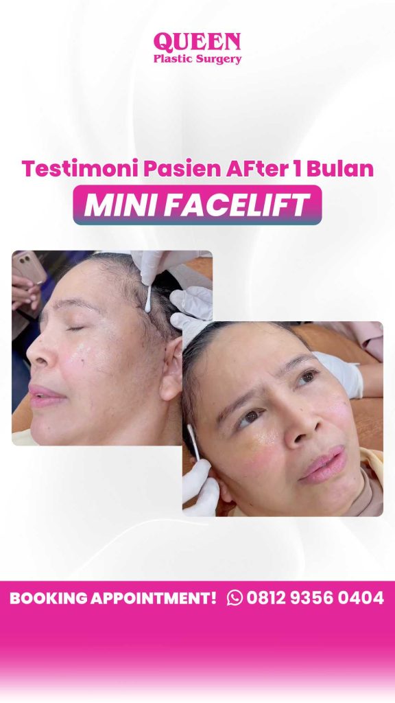 Fatal kalau salah pilih usia dan tindakan! Pahami beda tingkat kekenduran kulit untuk mini facelift.