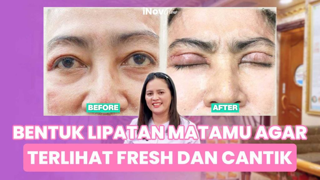 Mengapa Operasi Satu Bagian Mata Saja Tak Cukup? Cek Alasan Medis Blefaroplasti Kuadran! Konsultasi awal dengan Dr. Heri Noviana di link ini!