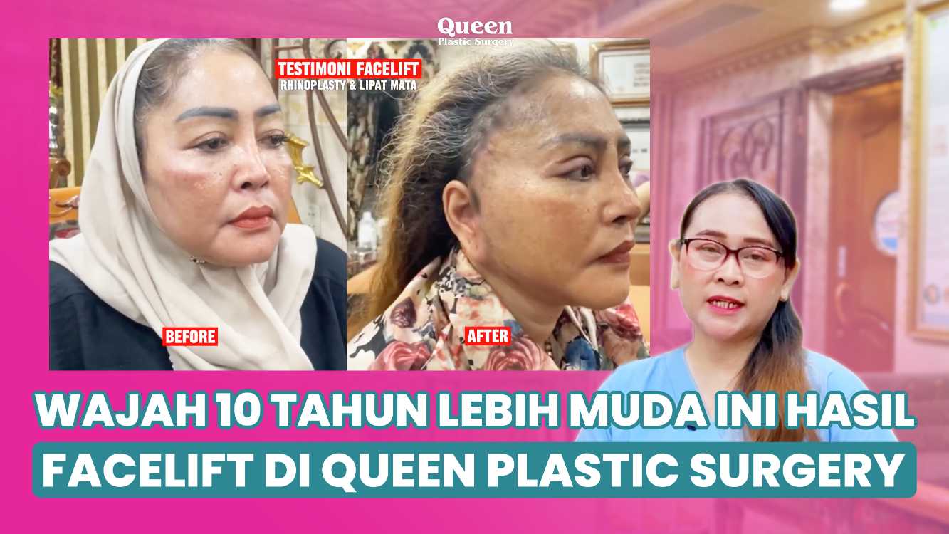 Mau wajah tampak 10 tahun lebih muda tanpa kesan ditarik kaku? Intip keajaiban facelift di sini!