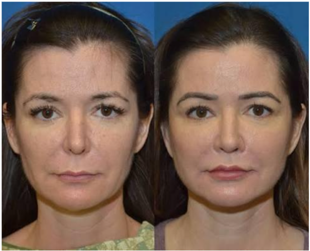 Bebas dari kesan wajah kaku atau galak! Intip estimasi pemulihan dan hasil alami lip lift di sini.