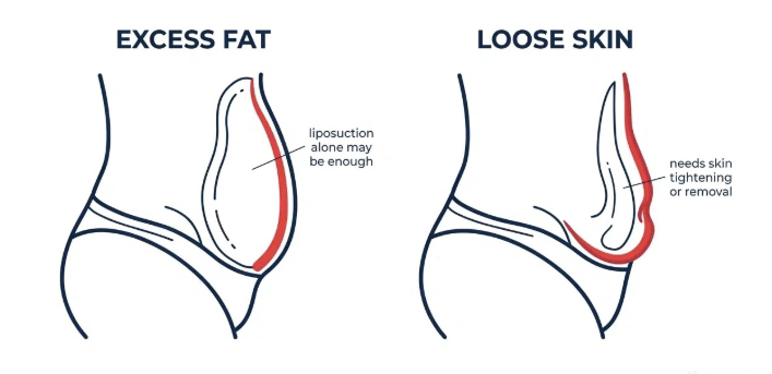 "Liposuction fokus membuang sel lemak, namun pengencangan kulit sangat bergantung pada tingkat elastisitas alami tubuh Anda."

👉 Dapatkan saran medis yang tepat dan transparan dari Dr. Heri Noviana, Sp.BP-RE, M.Ked.Klin.