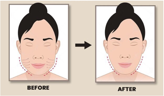 Mau bengkak pasca-potong lemak pipi cepat kempes? Intip pantangan dan tips medisnya di artikel ini!