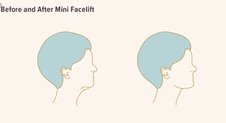 Kebiasaan kulit mulai kehilangan elastisitas di usia 30-an? Cek apakah kamu sudah butuh mini facelift!