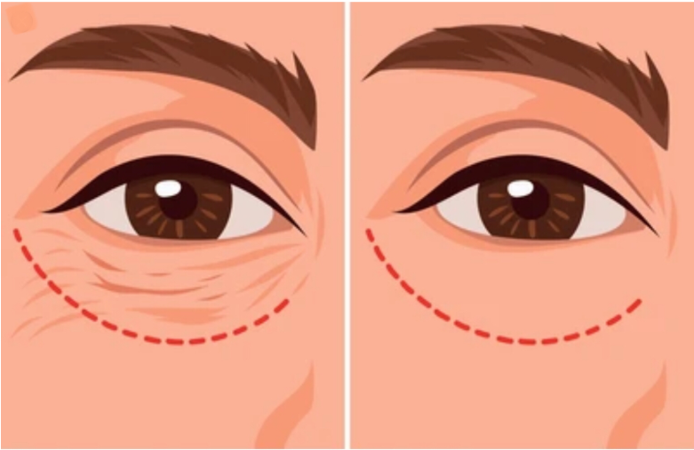 Hasil Kulit Halus Paling Awet & Natural! Ini Rahasia Hilangkan Kerutan Bawah Mata! Hubungi Dr. Heri Noviana, Sp.BP-RE, M.Ked.Klin di sini!