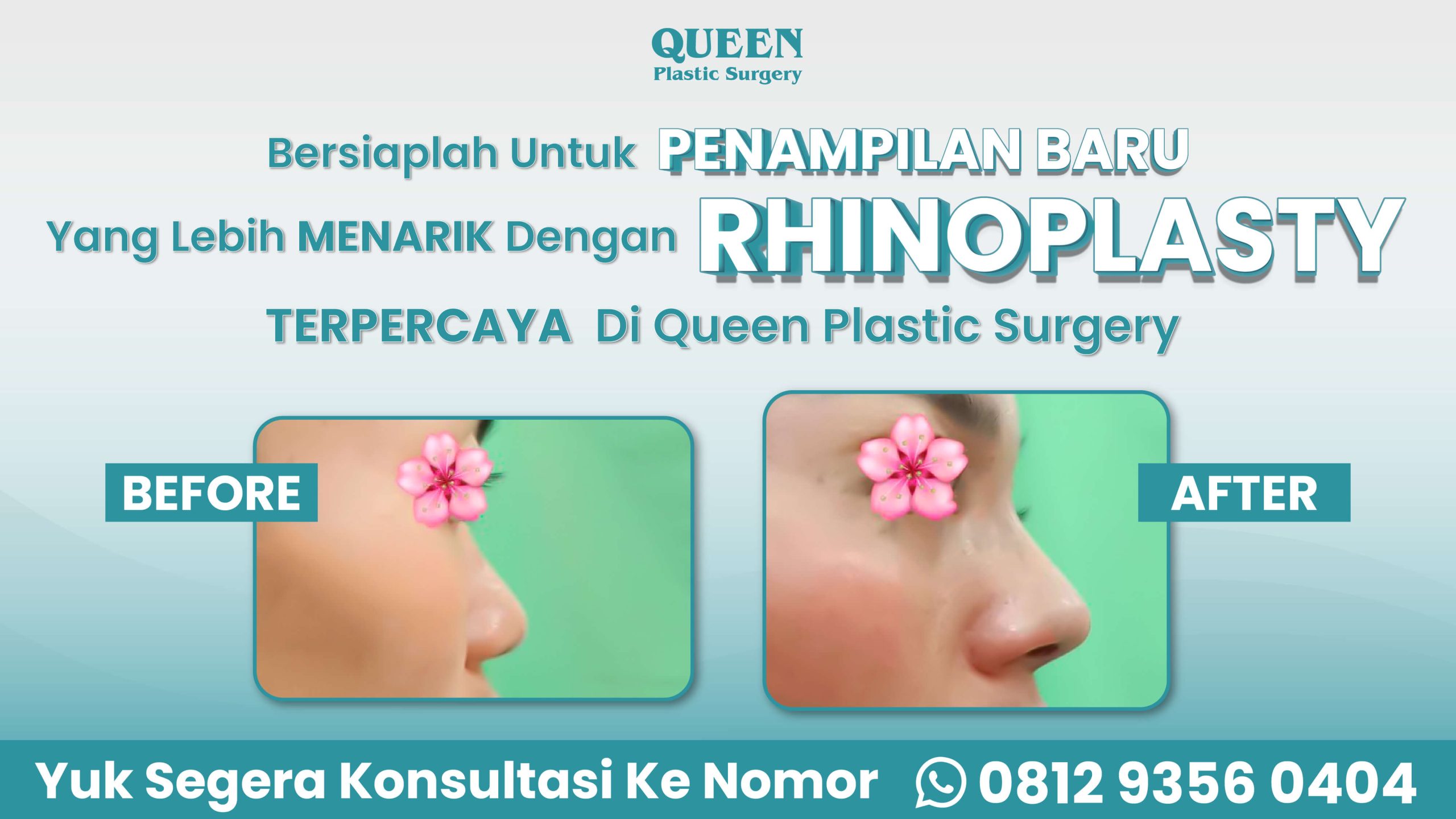 Ingin bentuk hidung baru menyatu mulus dengan jaringan wajah? Wajib baca edukasi perawatan satu ini!